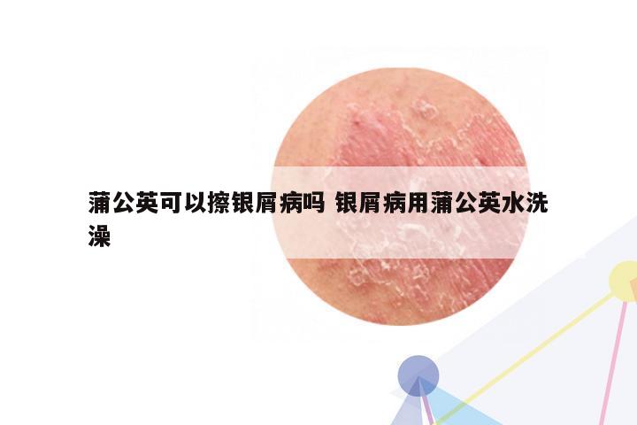 蒲公英可以擦银屑病吗 银屑病用蒲公英水洗澡