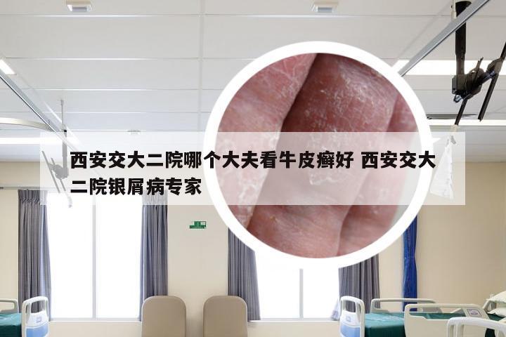 西安交大二院哪个大夫看牛皮癣好 西安交大二院银屑病专家