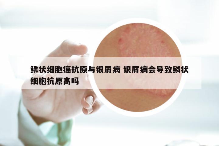 鳞状细胞癌抗原与银屑病 银屑病会导致鳞状细胞抗原高吗