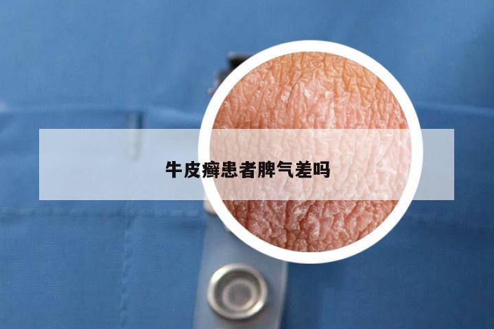 牛皮癣患者脾气差吗