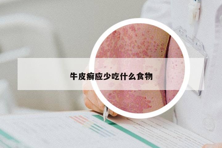 牛皮癣应少吃什么食物