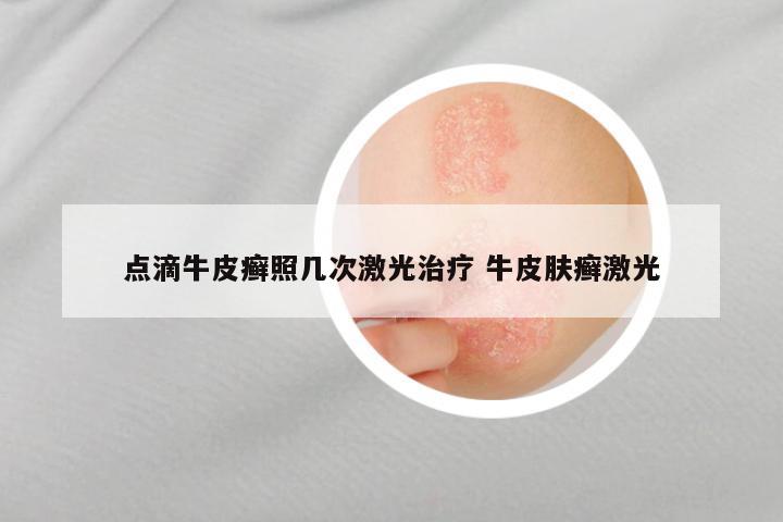 点滴牛皮癣照几次激光治疗 牛皮肤癣激光