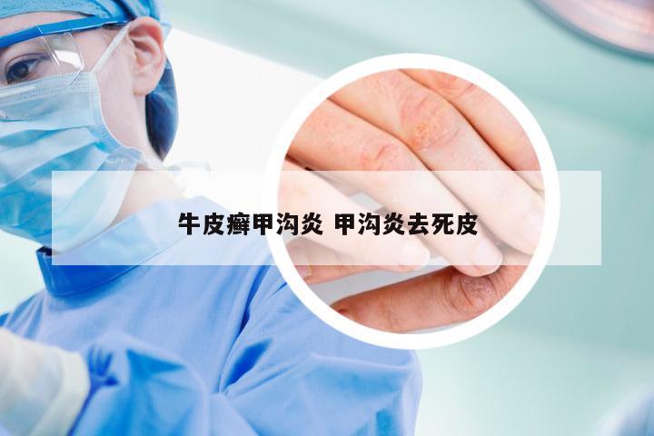牛皮癣甲沟炎 甲沟炎去死皮