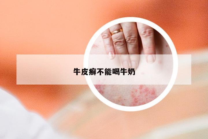 牛皮癣不能喝牛奶