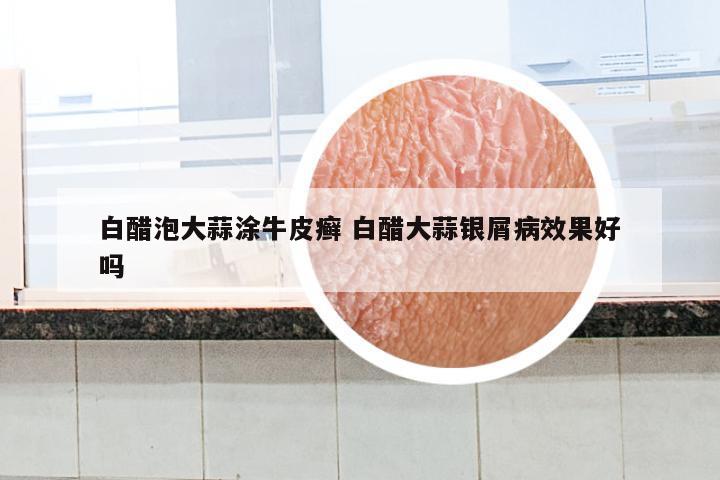 白醋泡大蒜涂牛皮癣 白醋大蒜银屑病效果好吗