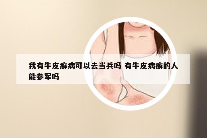 我有牛皮癣病可以去当兵吗 有牛皮病癣的人能参军吗