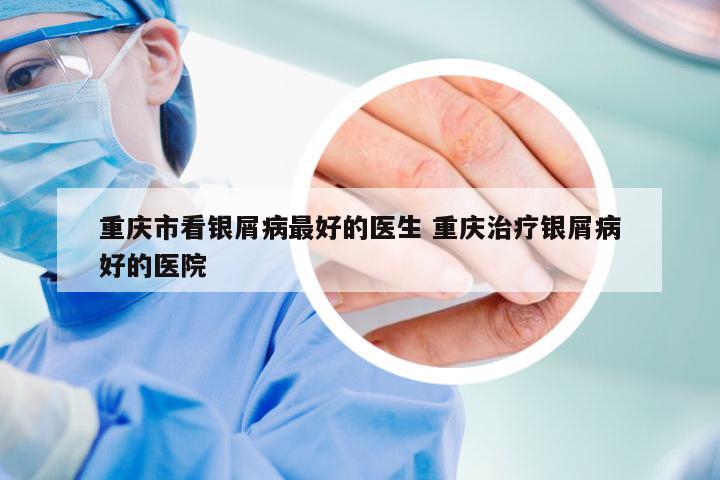 重庆市看银屑病最好的医生 重庆治疗银屑病好的医院