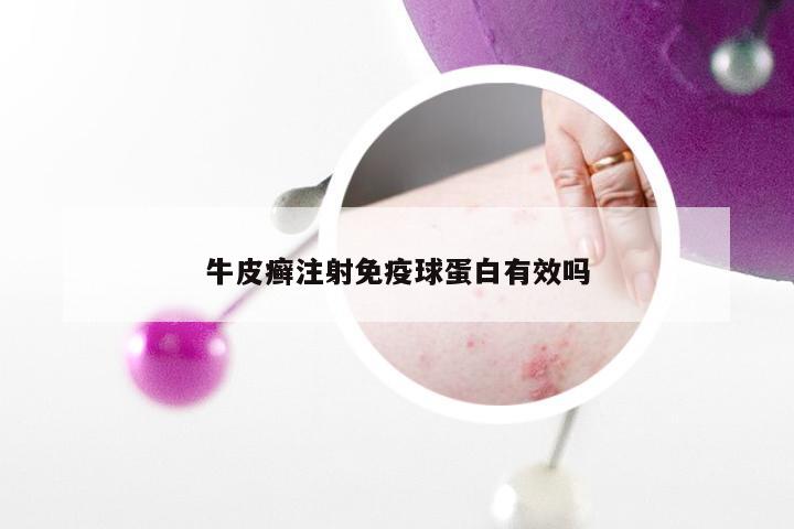 牛皮癣注射免疫球蛋白有效吗