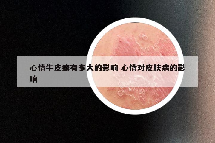 心情牛皮癣有多大的影响 心情对皮肤病的影响