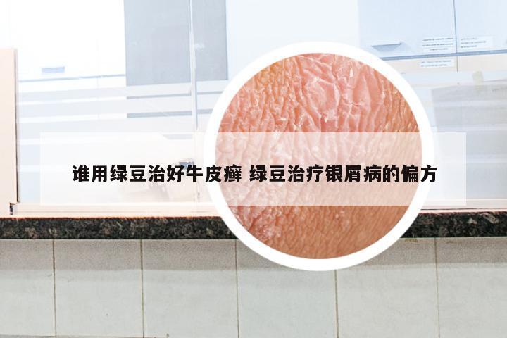 谁用绿豆治好牛皮癣 绿豆治疗银屑病的偏方