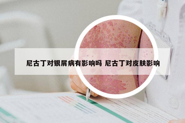 尼古丁对银屑病有影响吗 尼古丁对皮肤影响