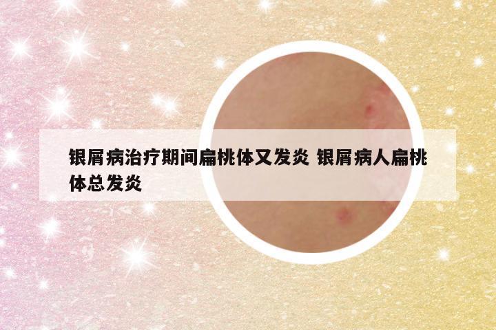 银屑病治疗期间扁桃体又发炎 银屑病人扁桃体总发炎