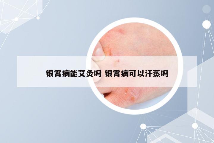 银霄病能艾灸吗 银霄病可以汗蒸吗