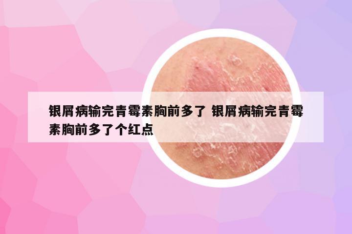 银屑病输完青霉素胸前多了 银屑病输完青霉素胸前多了个红点