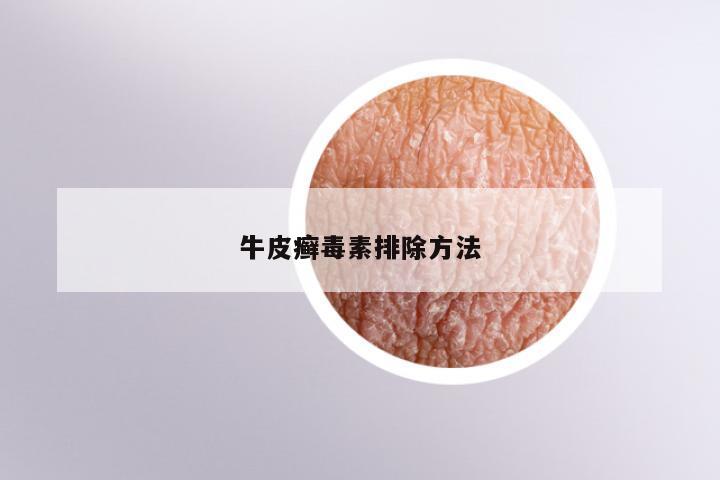 牛皮癣毒素排除方法