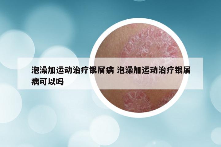 泡澡加运动治疗银屑病 泡澡加运动治疗银屑病可以吗