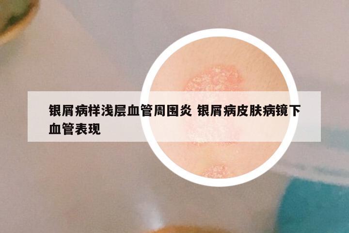 银屑病样浅层血管周围炎 银屑病皮肤病镜下血管表现