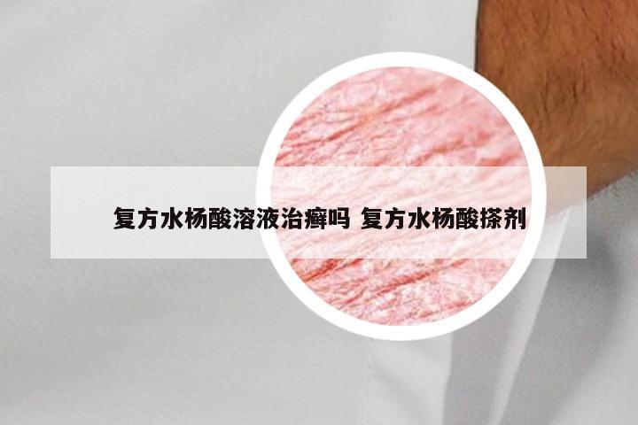 复方水杨酸溶液治癣吗 复方水杨酸搽剂