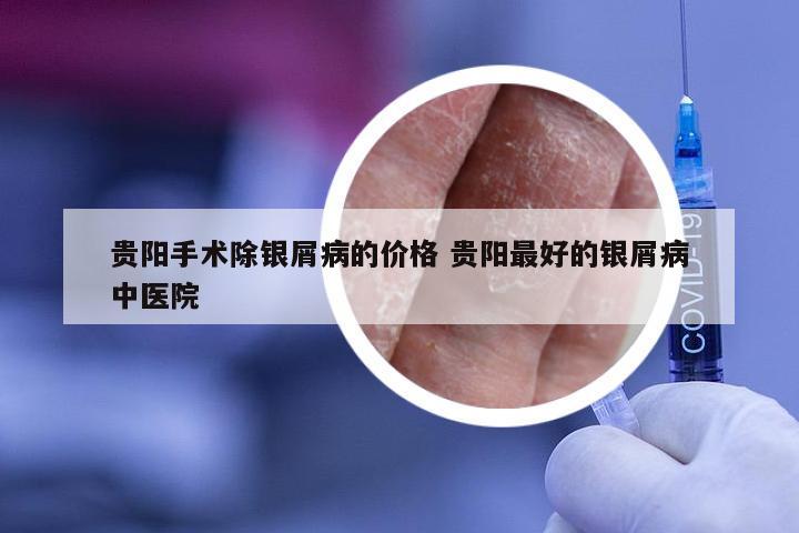 贵阳手术除银屑病的价格 贵阳最好的银屑病中医院