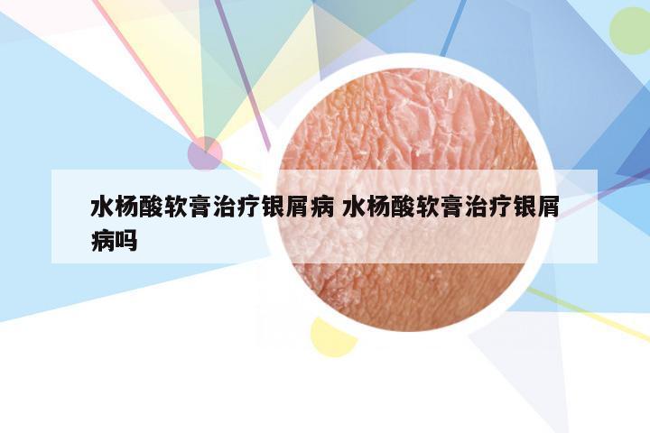 水杨酸软膏治疗银屑病 水杨酸软膏治疗银屑病吗