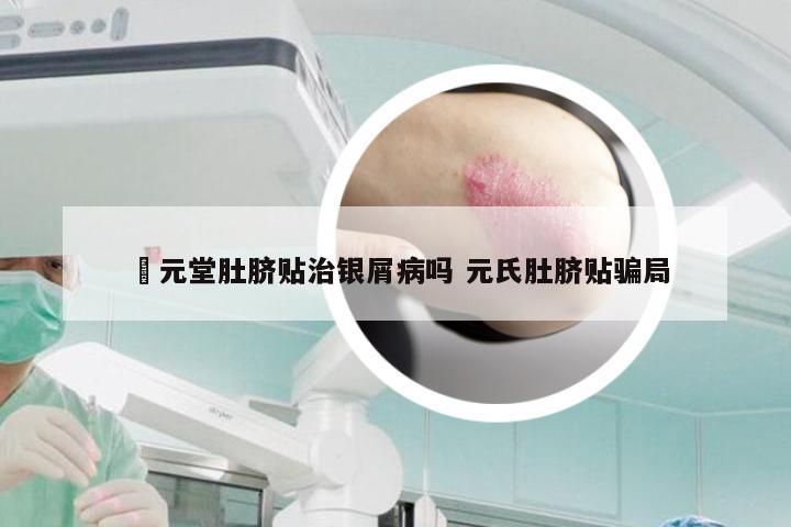 苙元堂肚脐贴治银屑病吗 元氏肚脐贴骗局