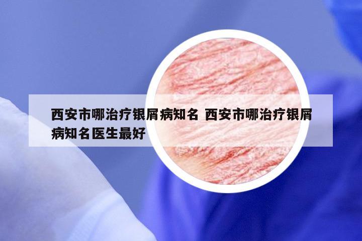 西安市哪治疗银屑病知名 西安市哪治疗银屑病知名医生最好