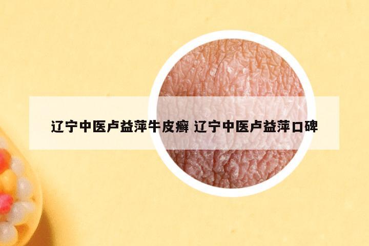 辽宁中医卢益萍牛皮癣 辽宁中医卢益萍口碑