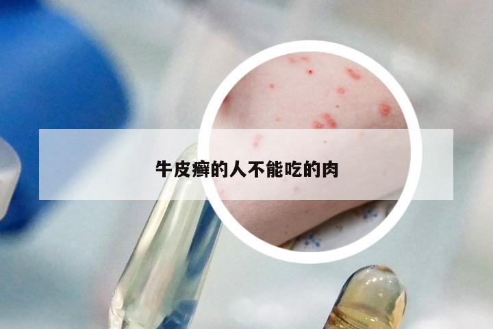 牛皮癣的人不能吃的肉