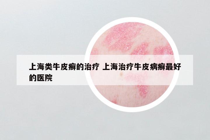 上海类牛皮癣的治疗 上海治疗牛皮病癣最好的医院