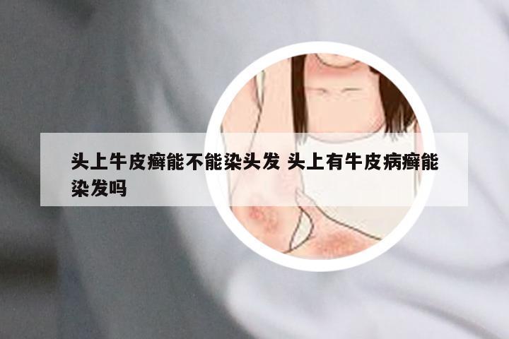 头上牛皮癣能不能染头发 头上有牛皮病癣能染发吗