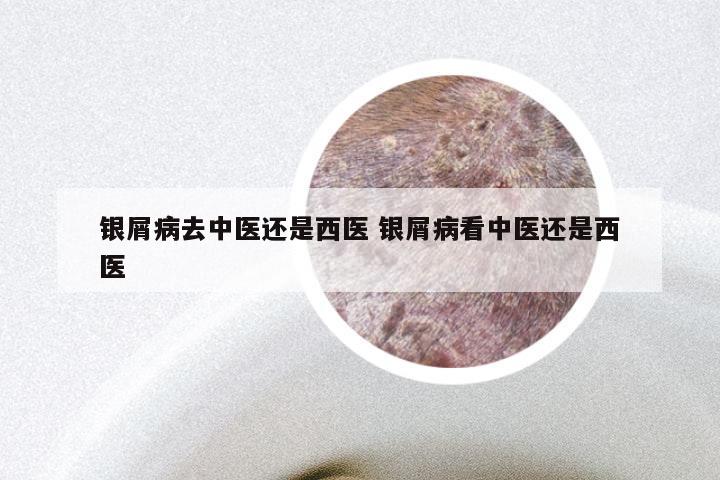 银屑病去中医还是西医 银屑病看中医还是西医