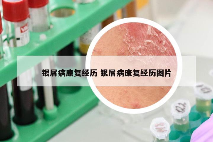 银屑病康复经历 银屑病康复经历图片