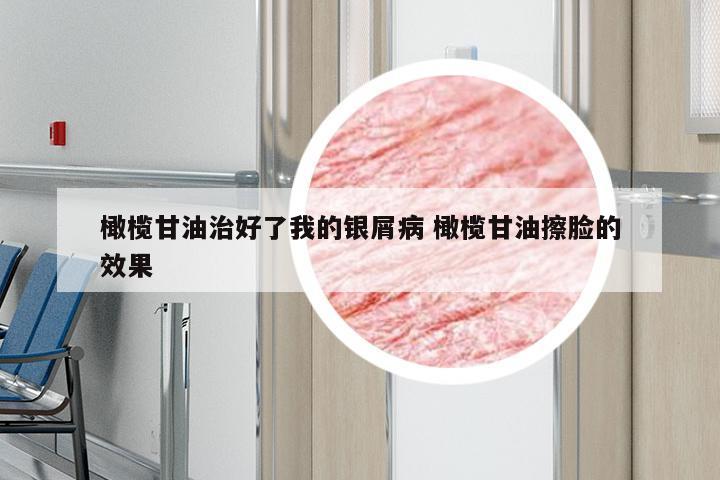 橄榄甘油治好了我的银屑病 橄榄甘油擦脸的效果