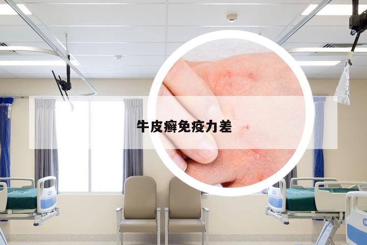 牛皮癣免疫力差