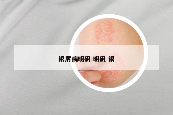 银屑病明矾 明矾 银