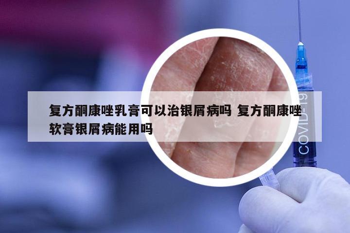 复方酮康唑乳膏可以治银屑病吗 复方酮康唑软膏银屑病能用吗