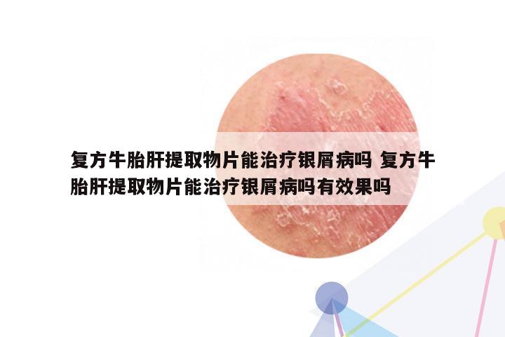 复方牛胎肝提取物片能治疗银屑病吗 复方牛胎肝提取物片能治疗银屑病吗有效果吗