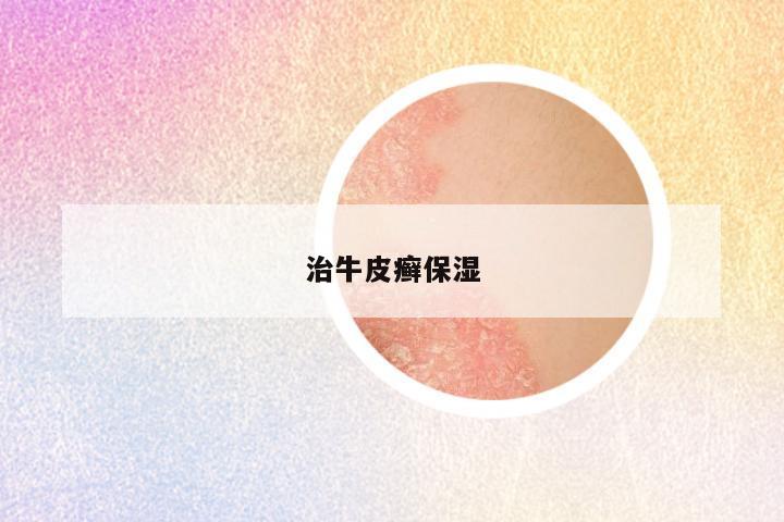 治牛皮癣保湿