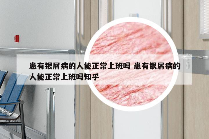 患有银屑病的人能正常上班吗 患有银屑病的人能正常上班吗知乎