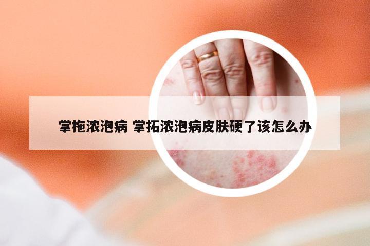 掌拖浓泡病 掌拓浓泡病皮肤硬了该怎么办