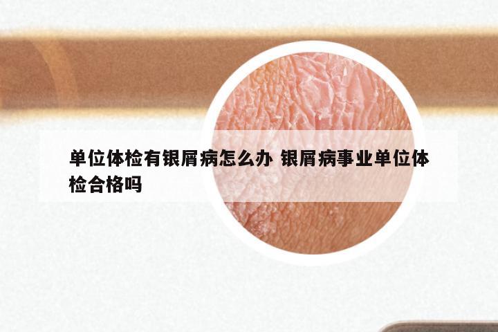 单位体检有银屑病怎么办 银屑病事业单位体检合格吗