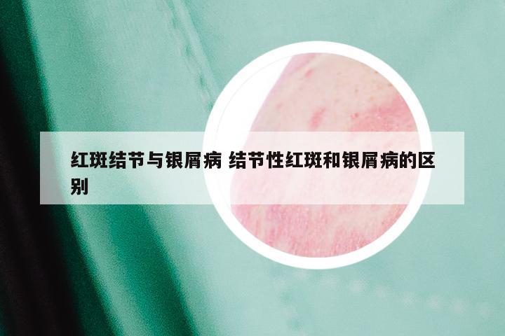红斑结节与银屑病 结节性红斑和银屑病的区别