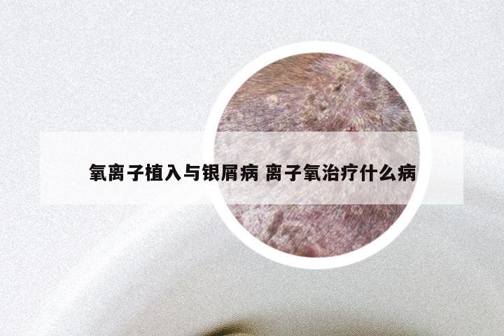 氧离子植入与银屑病 离子氧治疗什么病