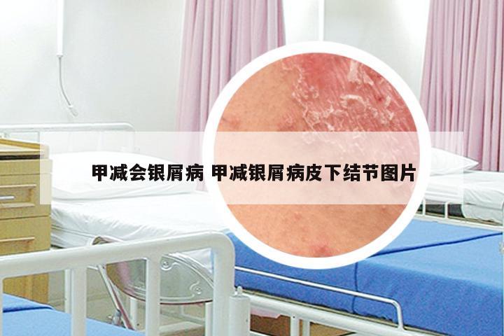 甲减会银屑病 甲减银屑病皮下结节图片