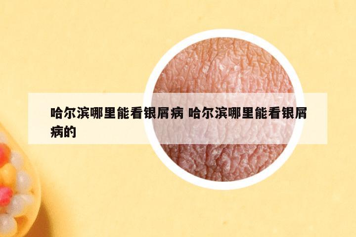 哈尔滨哪里能看银屑病 哈尔滨哪里能看银屑病的