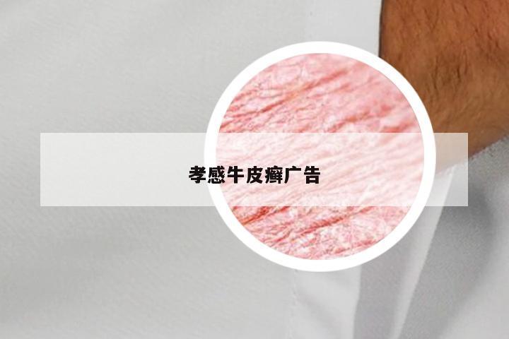 孝感牛皮癣广告