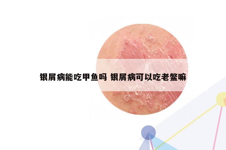 银屑病能吃甲鱼吗 银屑病可以吃老鳖嘛