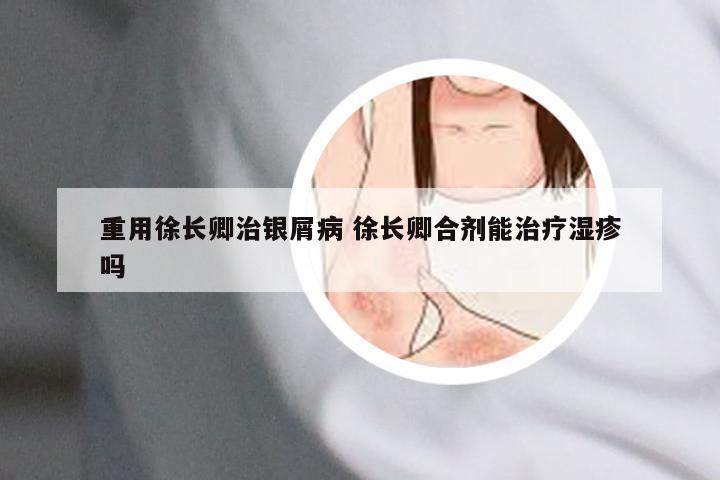 重用徐长卿治银屑病 徐长卿合剂能治疗湿疹吗