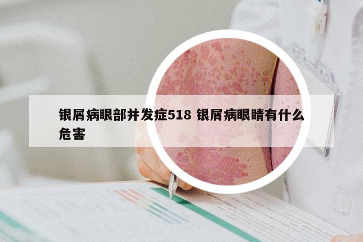 银屑病眼部并发症518 银屑病眼睛有什么危害