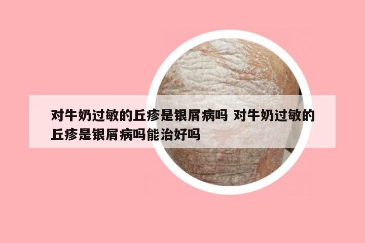 对牛奶过敏的丘疹是银屑病吗 对牛奶过敏的丘疹是银屑病吗能治好吗